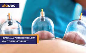 How to Find Cupping Therapy Near Me